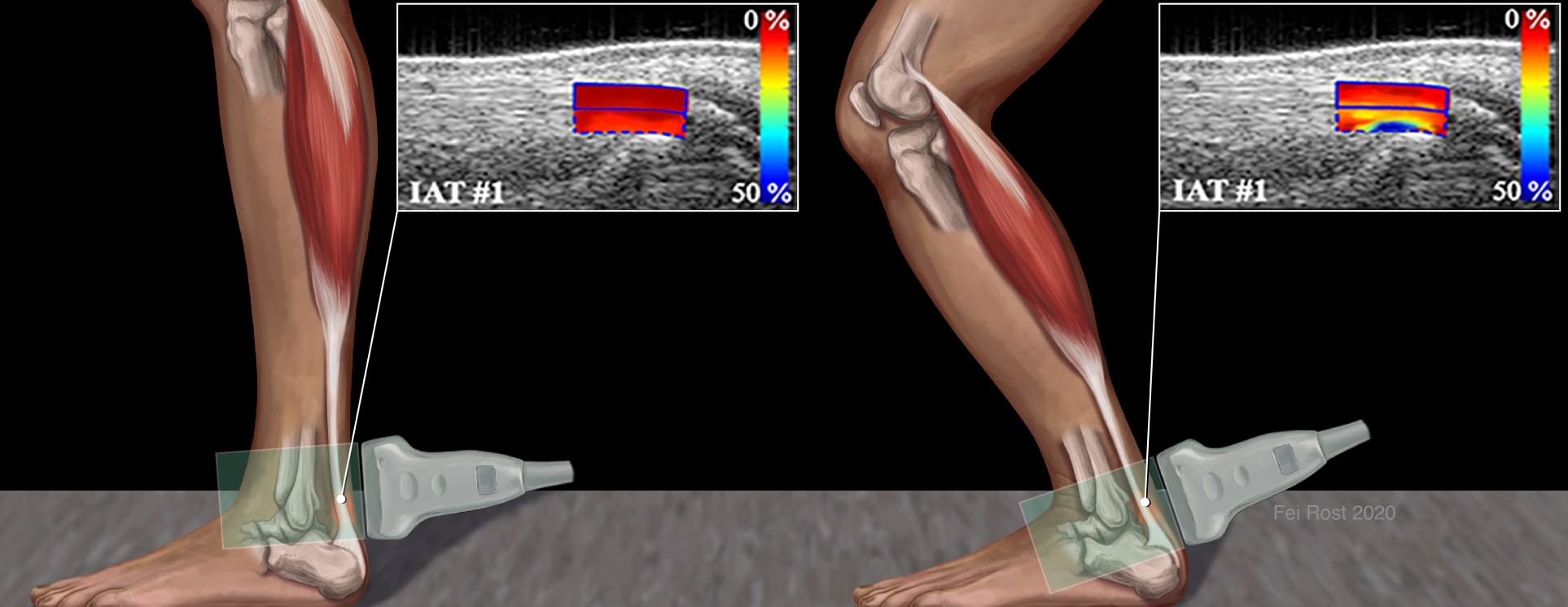 Ultrasound Elastography of Achilles Tendinopathy