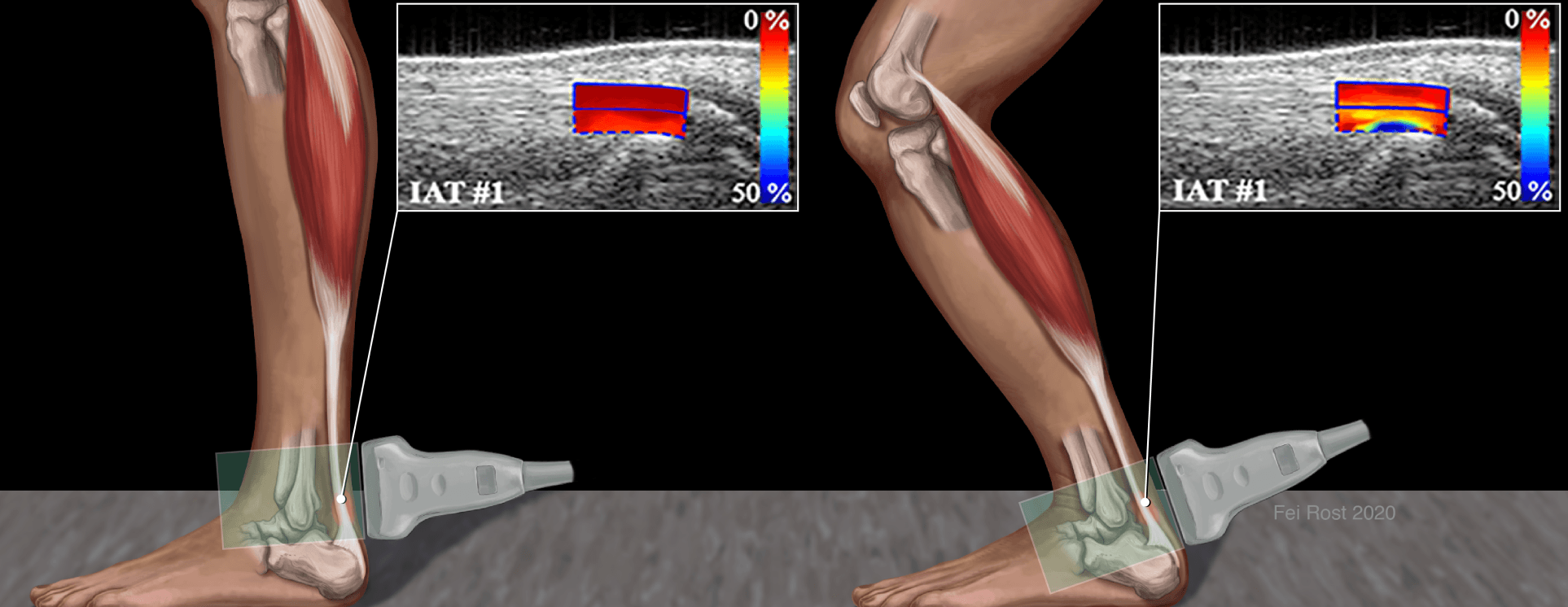illustration of an ultrasound of the Achilles tendon while standing and while the leg is bent.