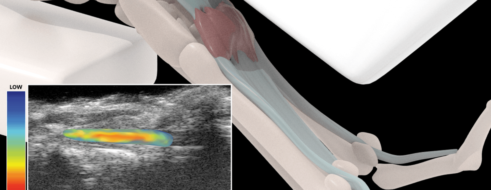 illustration and ultrasound image of a tendon.