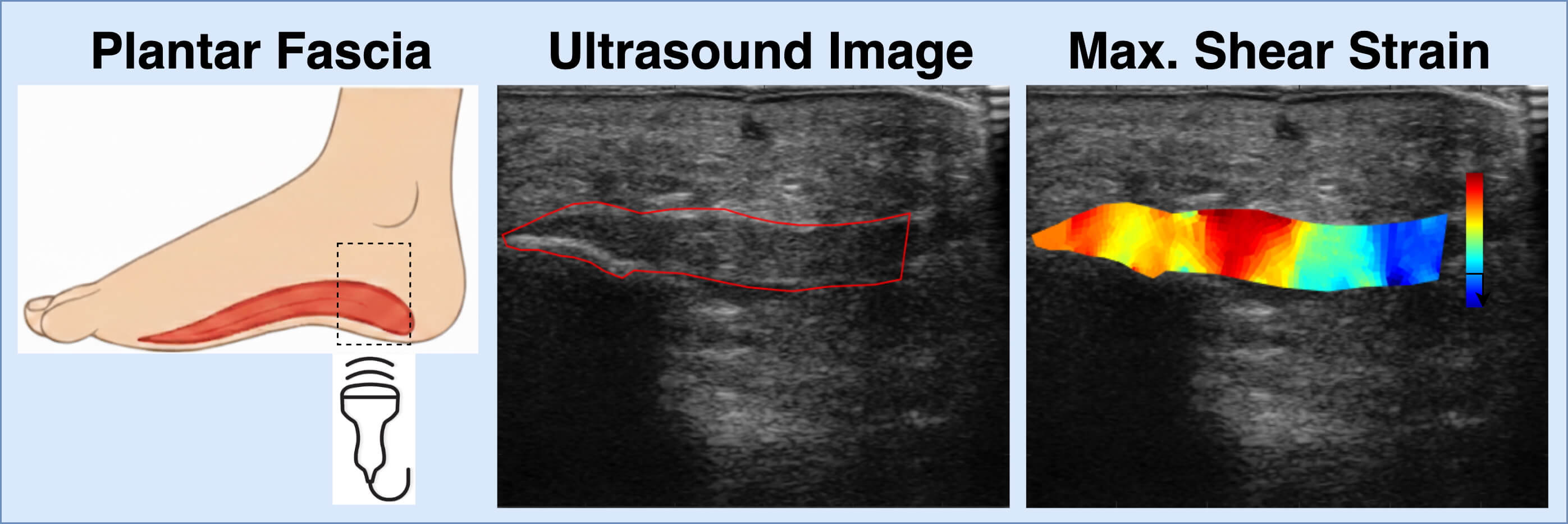 illustration of ultrasound of the bottom of a foot and the resulting data about plantar fasciitis.
