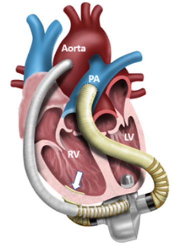 blood pump
