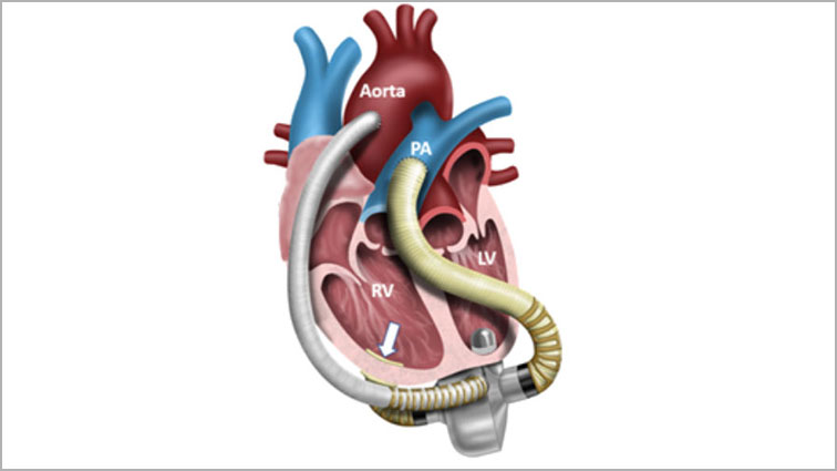 diagram of a heart pump.
