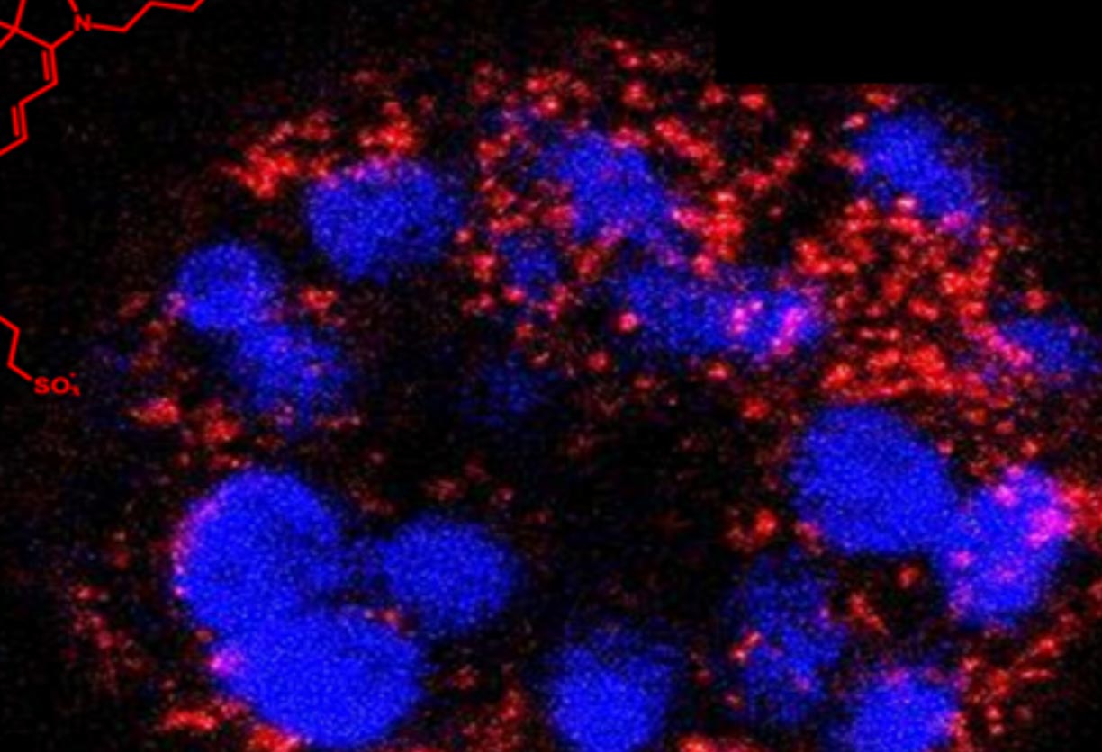 MRI scan of breast cancer cells using confocal fluorescence microscopy.