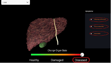 A computer model of a diseased liver.