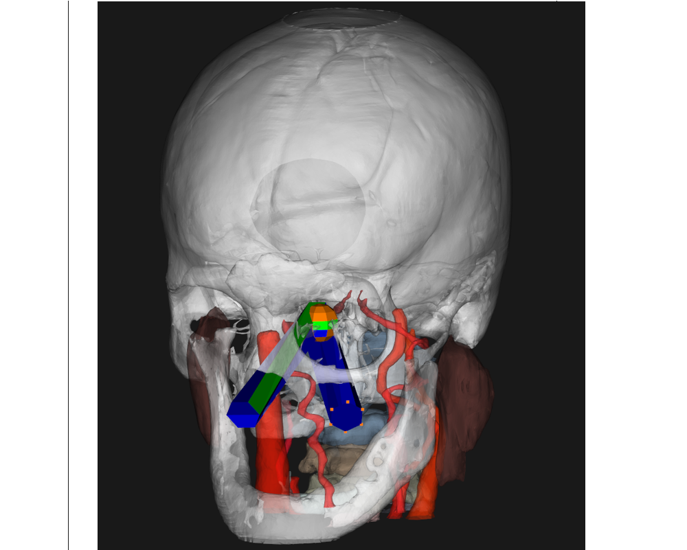 an image of a skull with colorful shapes indicating surgical processes.