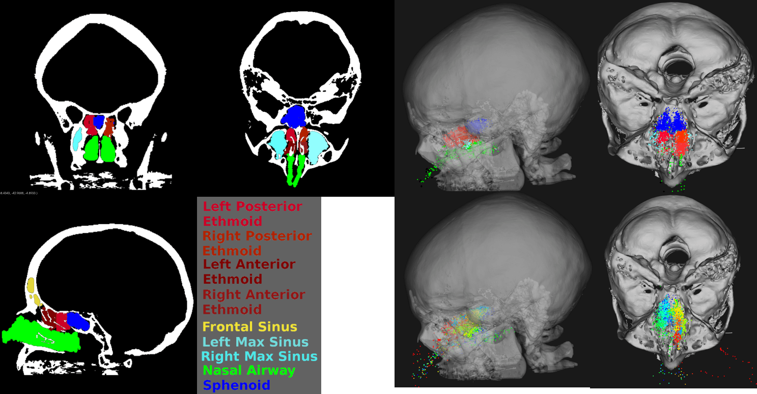 images of a skull from several perspective, with the different parts color coded.