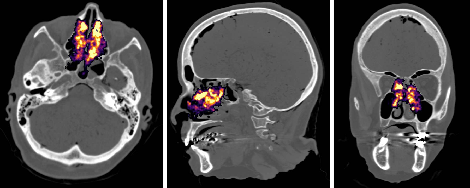 three images of a skull with area of concern highlighted.