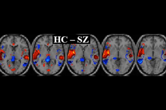 Picture of brain scan