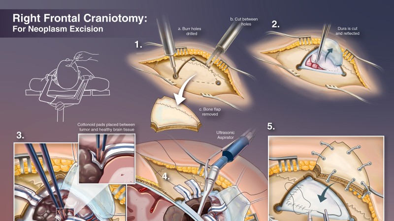 An illustration of a right frontal craniotomy procedure.