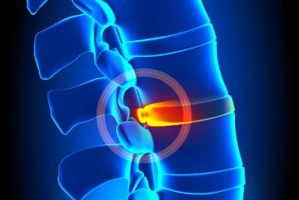 model showing inflammation of the spine.